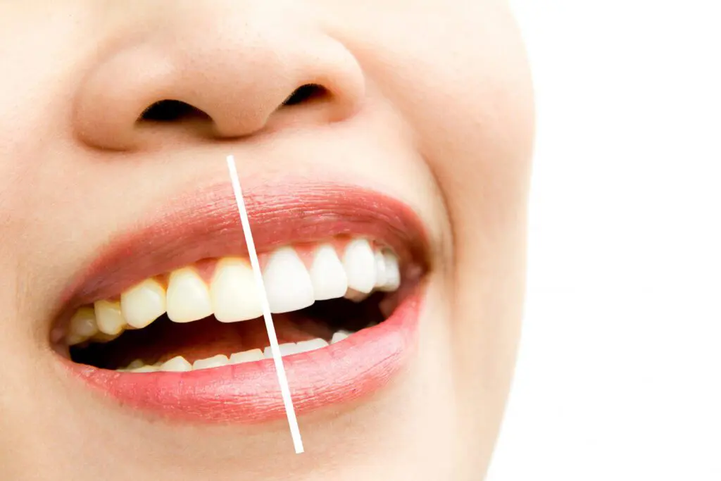 discolored teeth