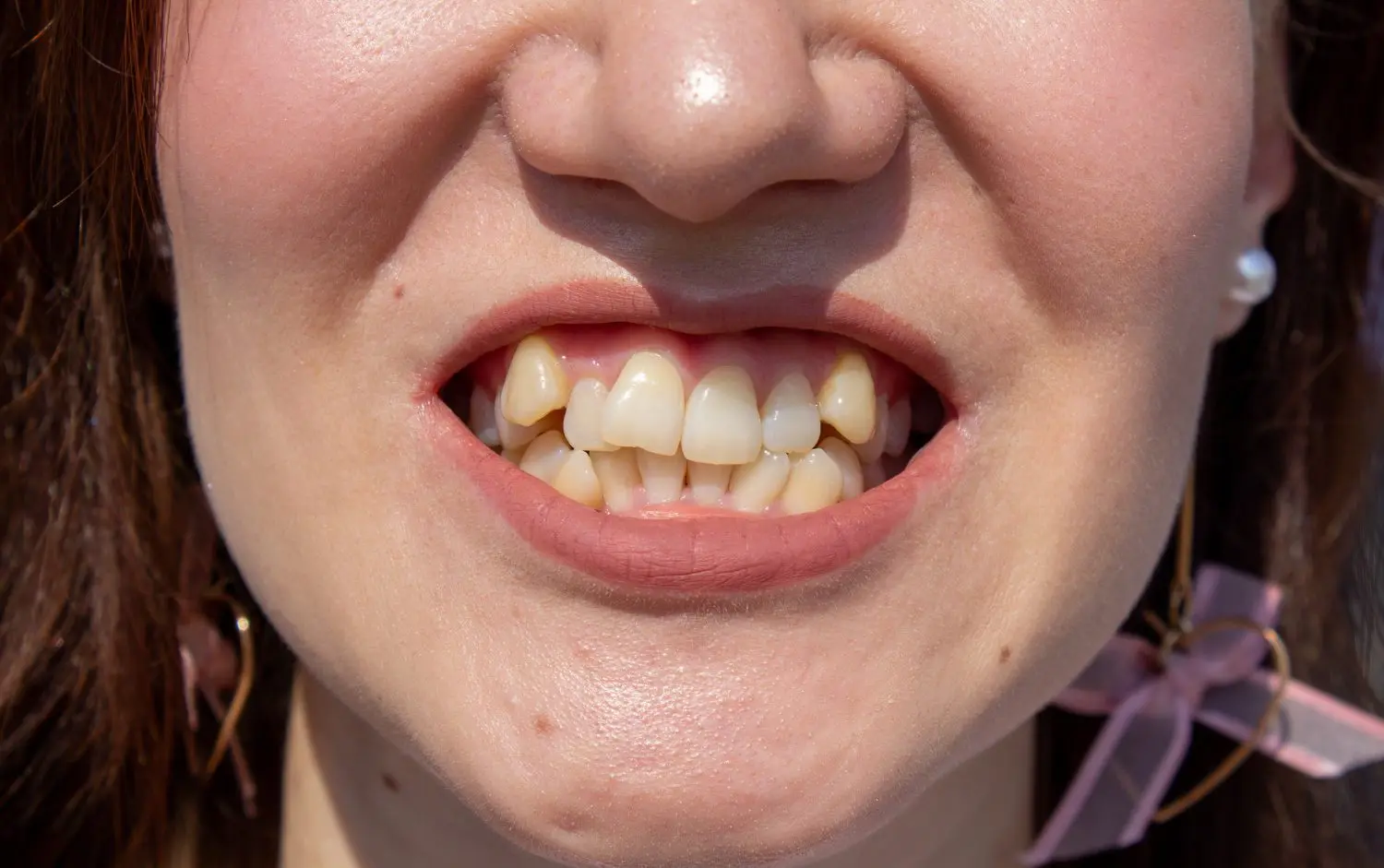 misshapen teeth