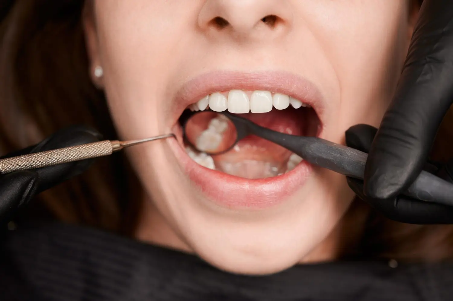 lost fillings