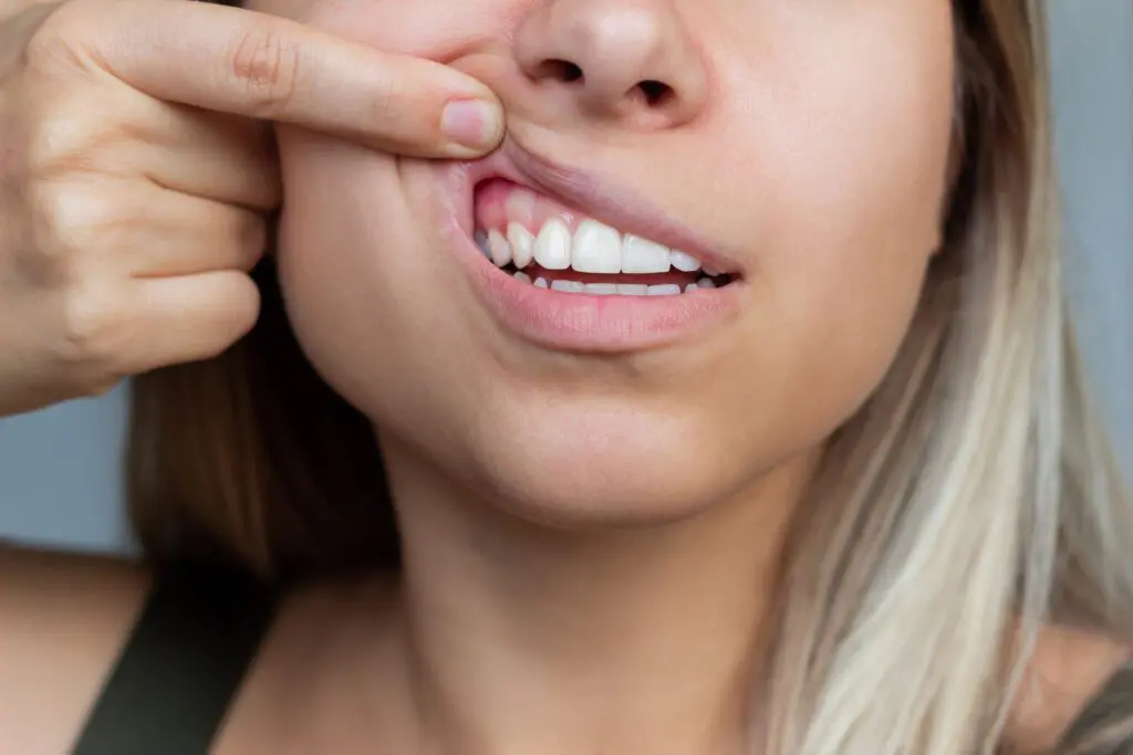 gum injuries