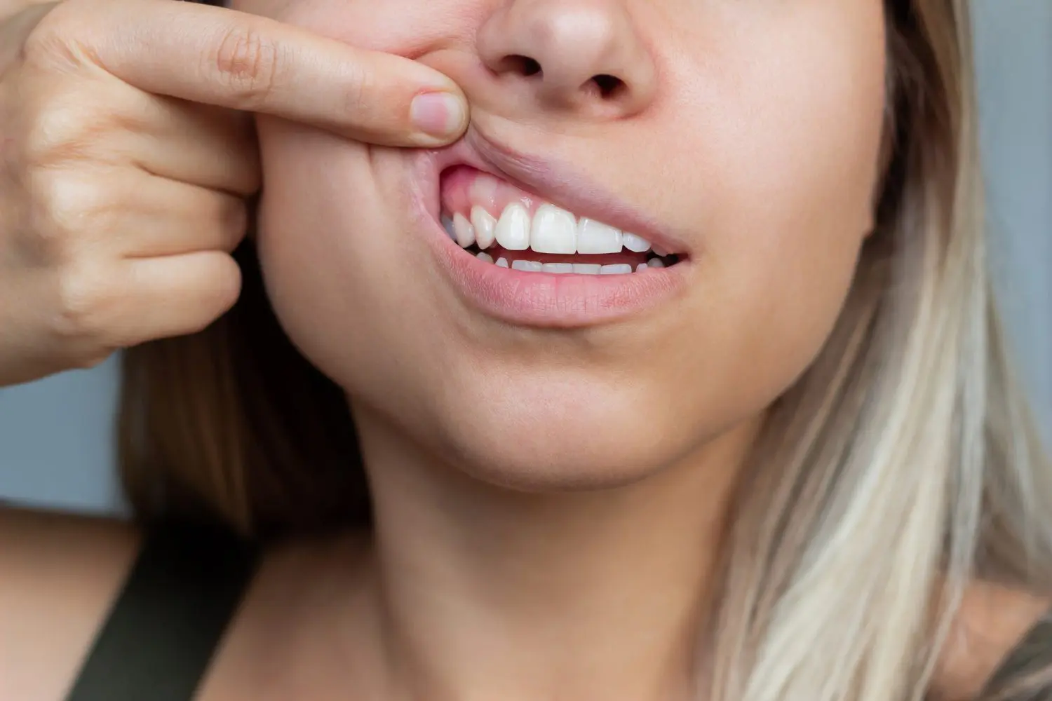gum injuries
