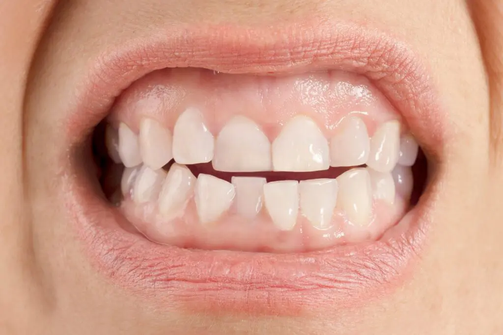 crossbite
