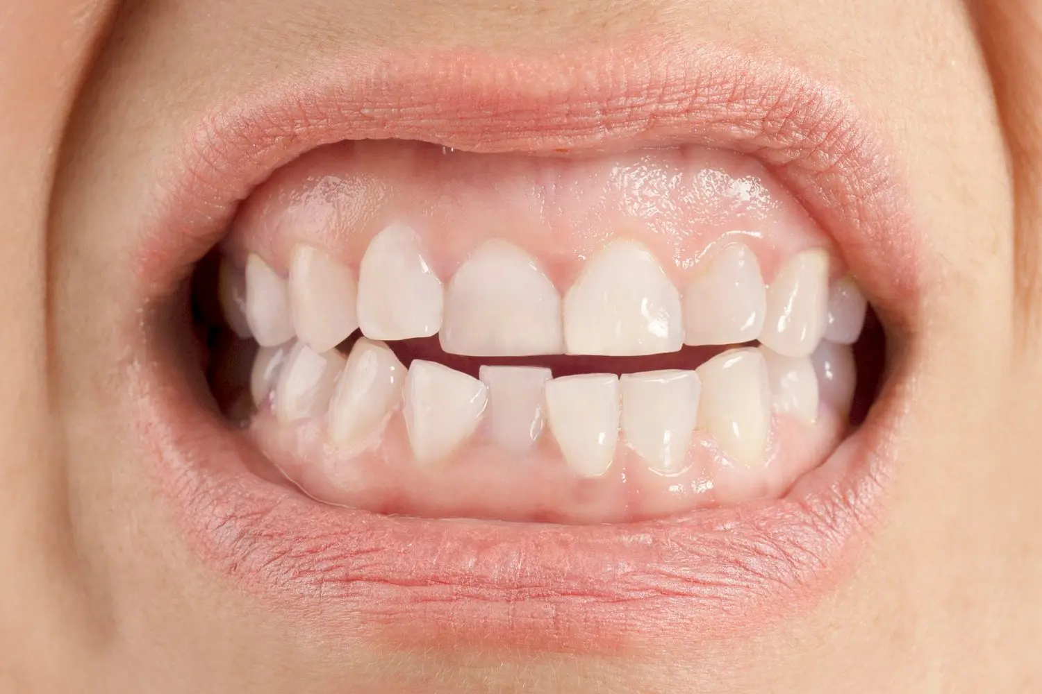 crossbite