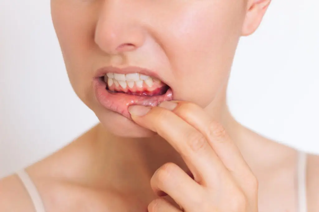 gingivitis