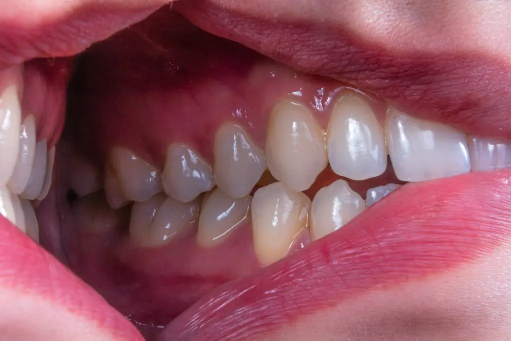Gum Disease