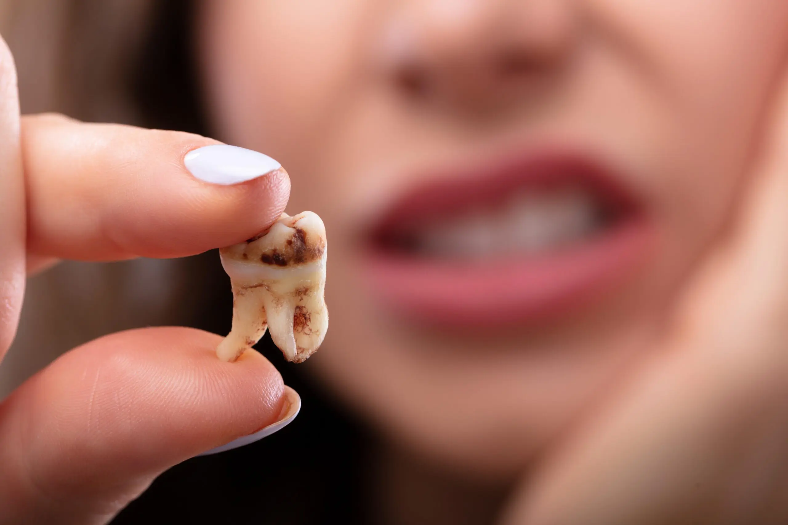 Knocked-Out Teeth