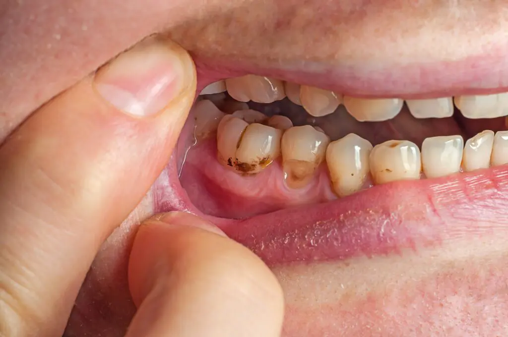 Plaque and Tartar Buildup