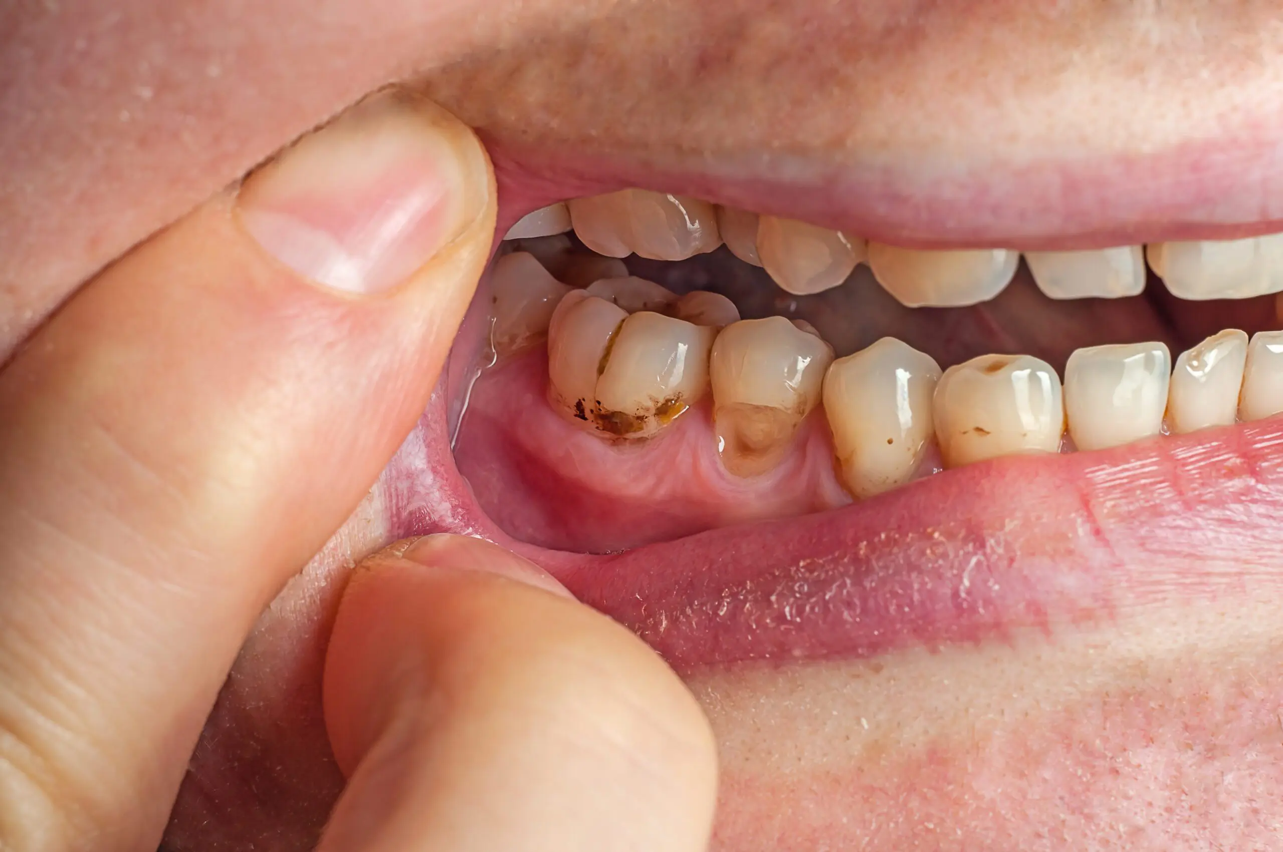 Plaque and Tartar Buildup
