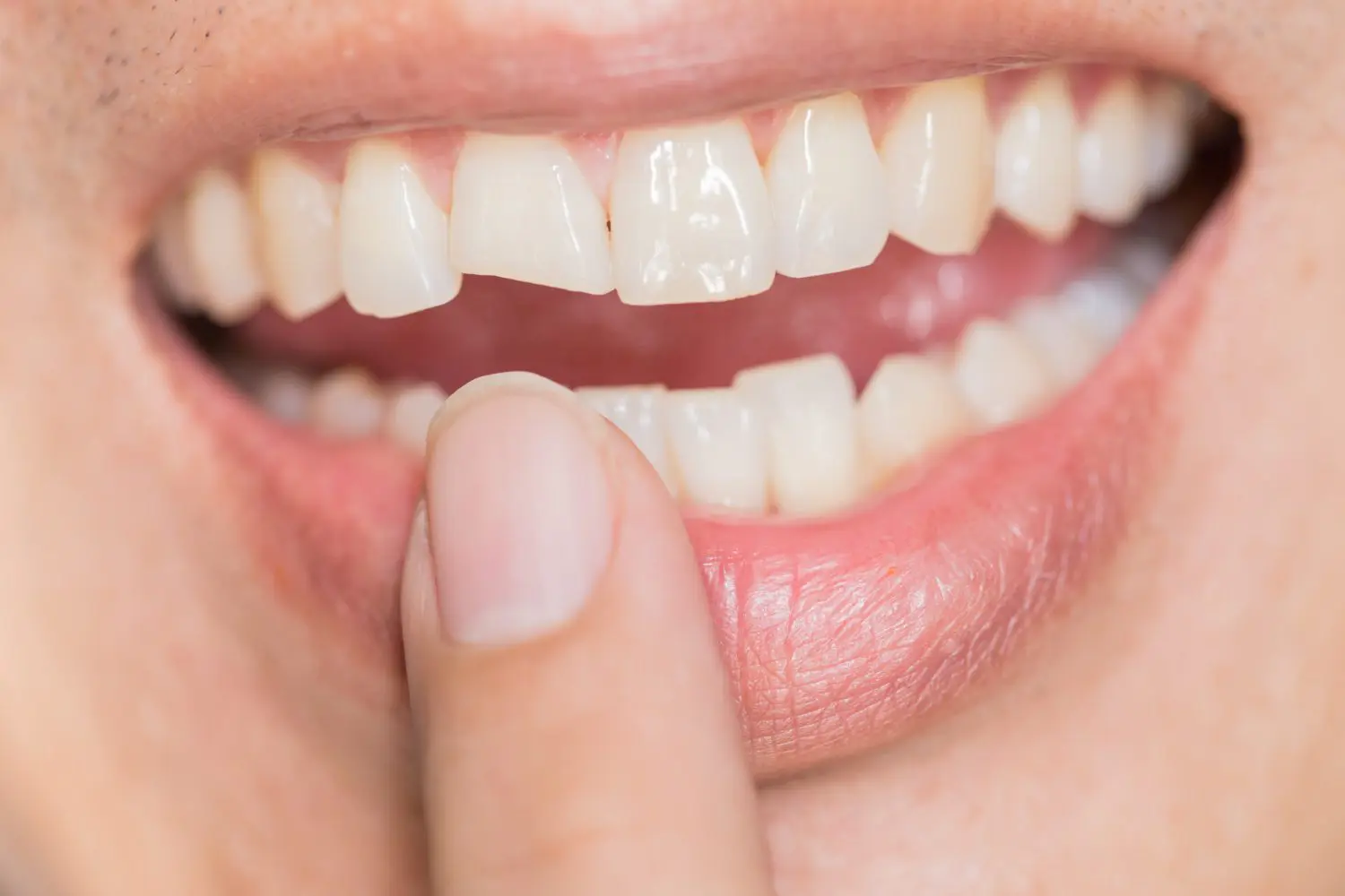 Chipped or Broken Teeth