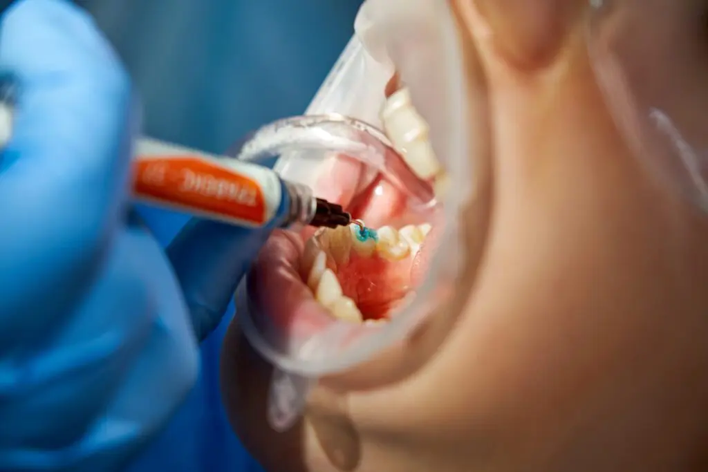Tooth-Colored Fillings