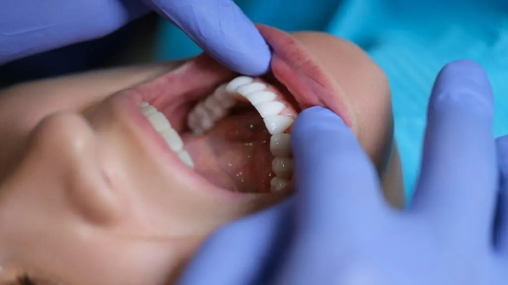 dental bonding