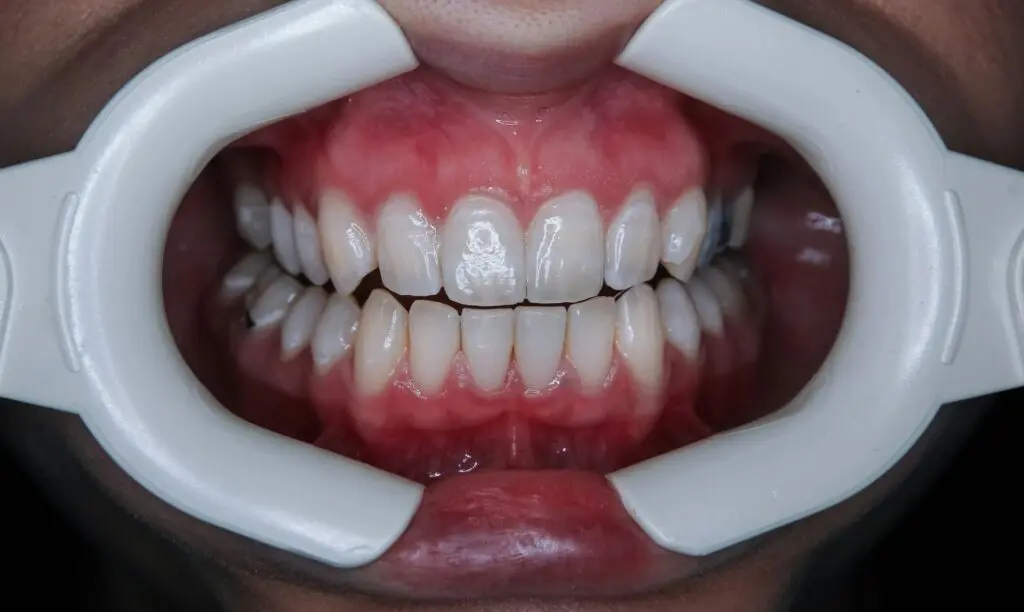 gums
