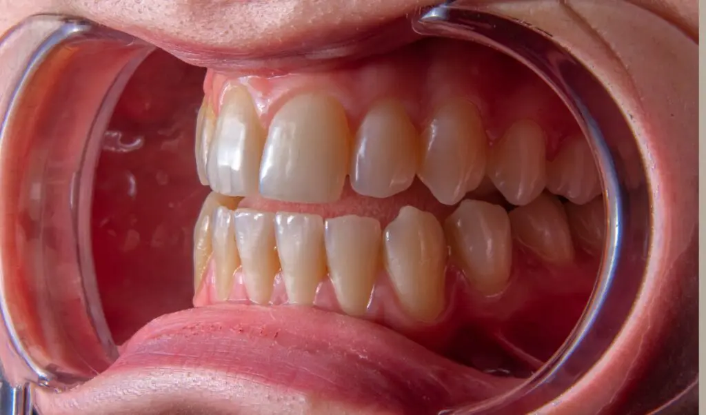 gum deep cleaning