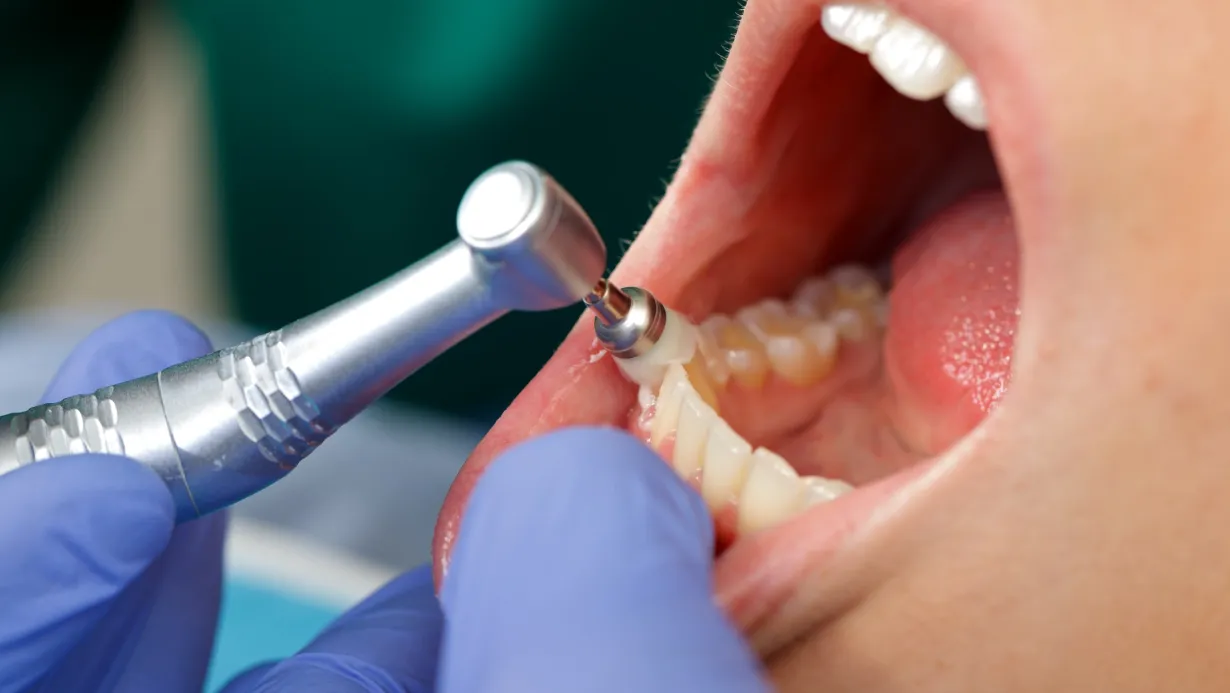 Dental Cleaning AFD